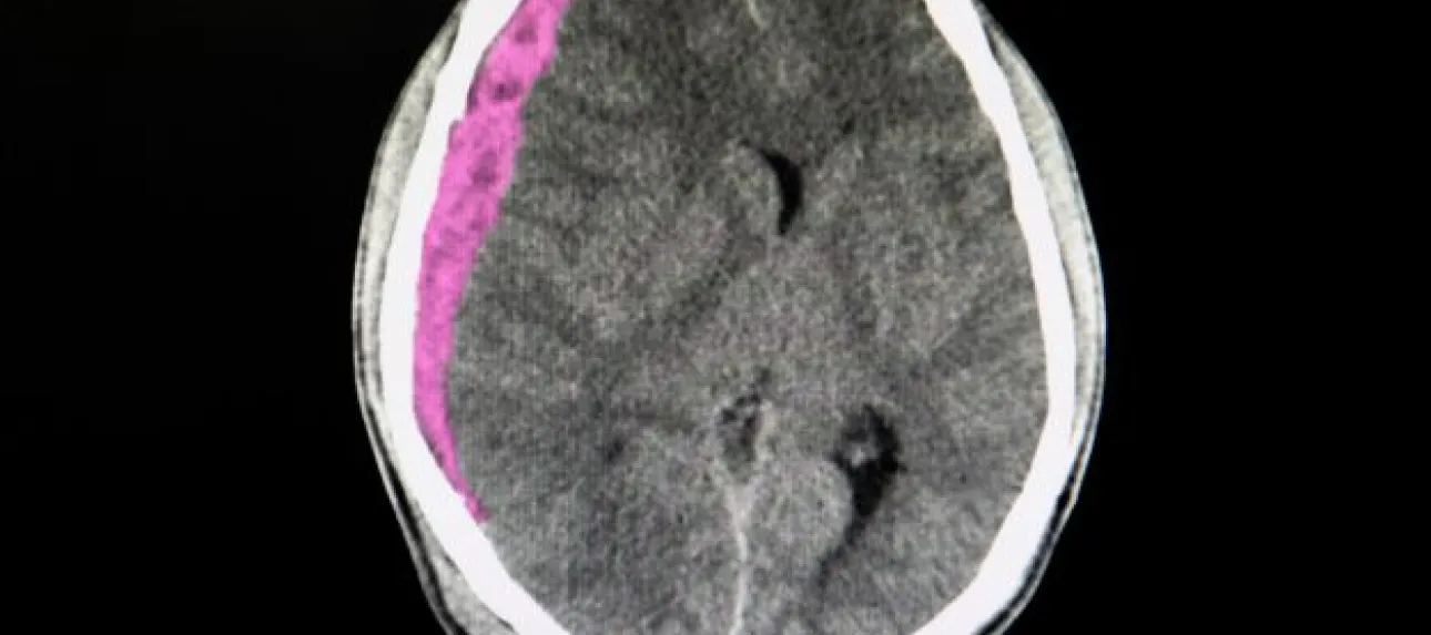 hématome sous dural