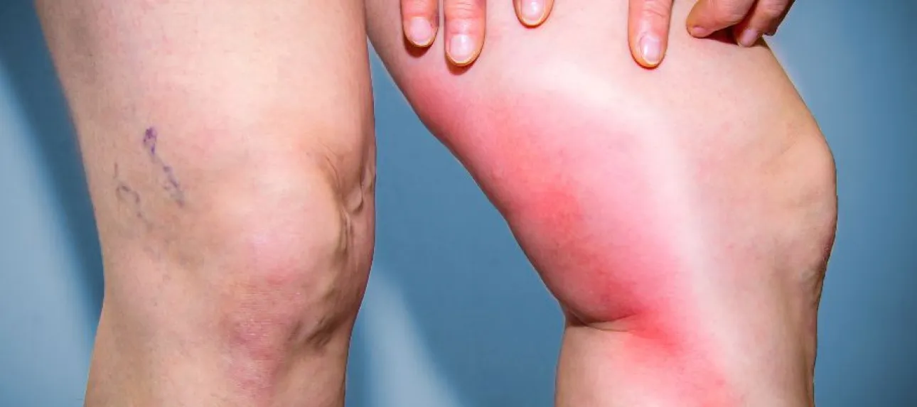 phlebite aux jambes