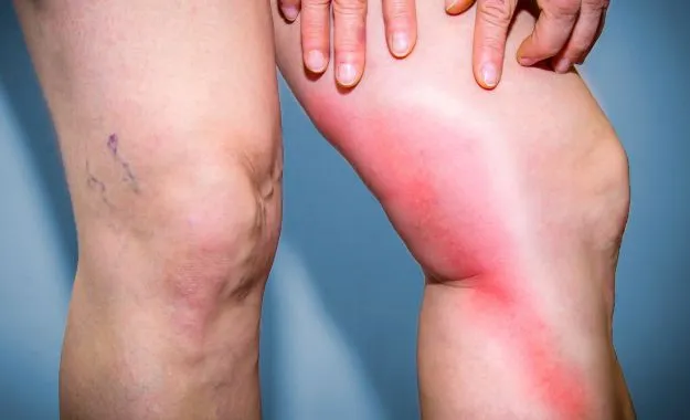 phlebite aux jambes
